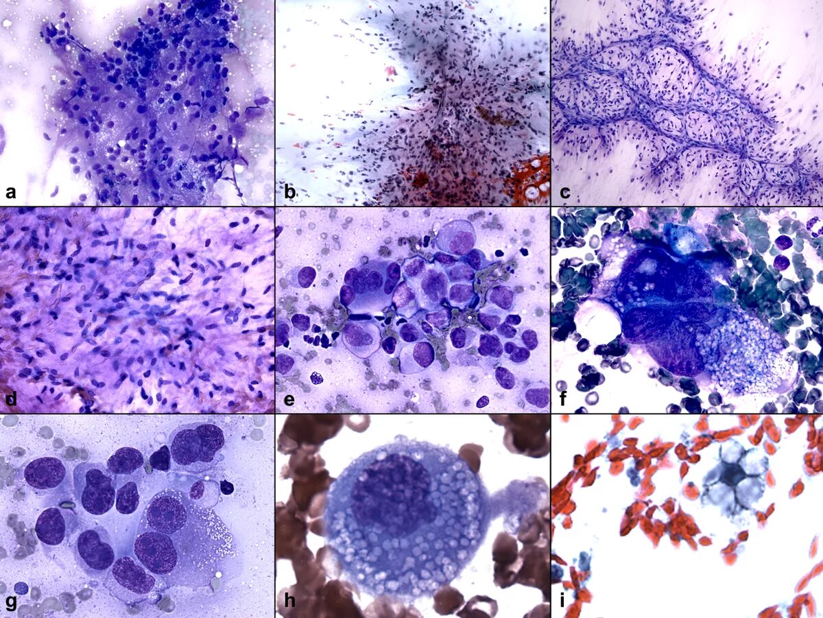 Цитологическое исследование пунктата. Гемангиосаркома цитология. Липосаркома цитология. Фибросаркома цитология. Липосаркома цитологическая картина.