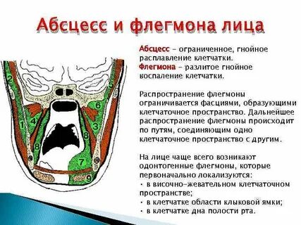 Мкб дна полости рта