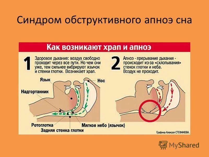 Заболевание апноэ во сне. Синдром обструктивного ночного апноэ. Синдромобструктивного апное сна. СОАС синдром обструктивного апноэ сна. Остановка дыхания во сне.