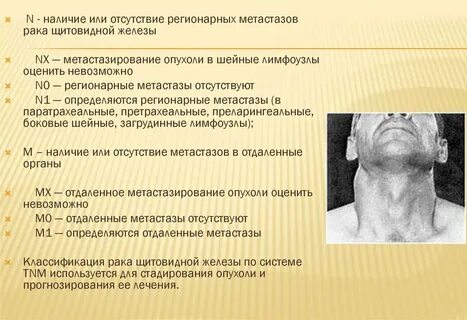 Щитовидная железа метастазы