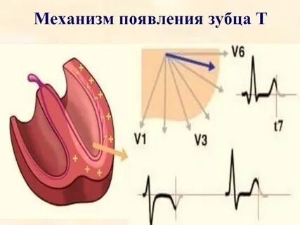 Низкий зубец на экг