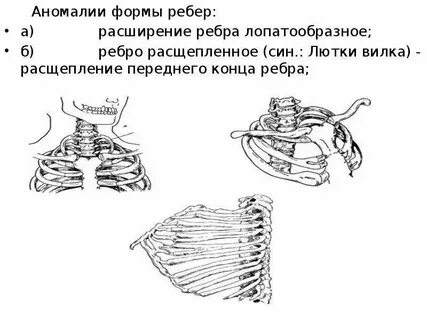 Аномалии строения грудины