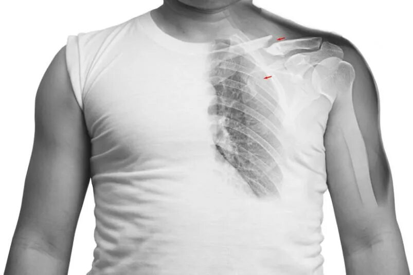 Рентгеновские снимки ребер перелом. Трещина ребра симптомы у взрослого. Перелом ребра сзади рентген. Перелом 9 ребра грудной клетки. Трещина ребра симптомы у взрослого.