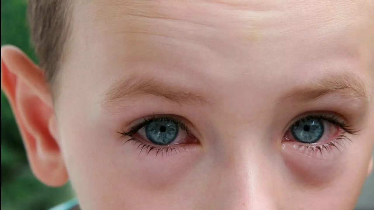 Конъюнктивит ребенка 6 лет. Аллергические глаза у детей. Поллинозный конъюнктивит.