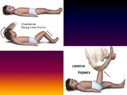 Симптом говорова годелье