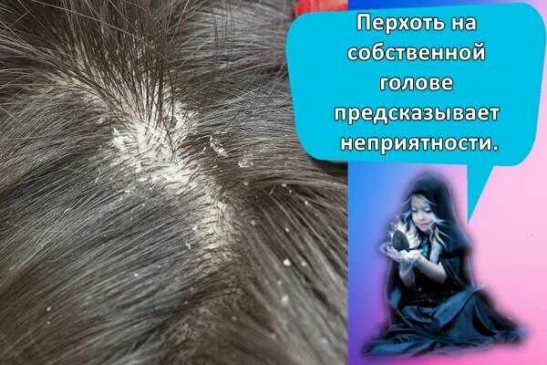 Сон перхоть в волосах. Сон перхоть в волосах. Сон перхоть в волосах. Огромная перхоть на голове. Чему снится перхоть хлопьями.