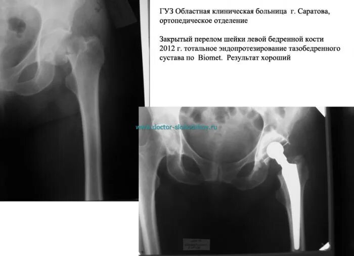 Эндопротезирование тазобедренного сустава после 3 месяцев. Рентгенографии цементного эндопротеза тазобедренного сустава. тотальное цементное эндопротезирование тазобедренного сустава. перелом шейки тазобедренного сустава рентген. вывих эндопротеза тазобедренного сустава рентген.