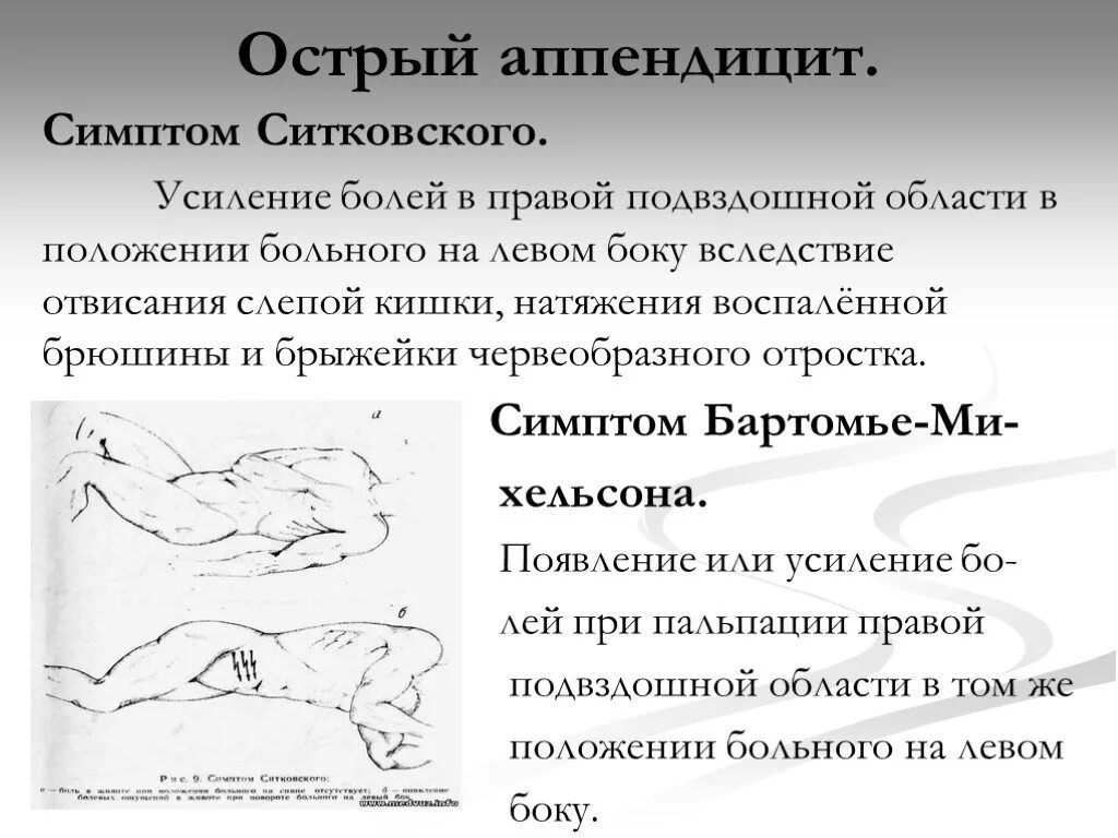 Для острого аппендицита характерен симптом. При остром аппендиците наблюдаются симптомы:. Симптом Ситковского острого аппендицита. Хирургические симптомы острого аппендицита.