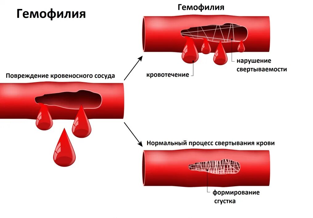 Нарушение свертываемости крови. Плохая свертываемость крови. Заболевания с нарушением свертываемости крови. Гемофилия нарушение свертываемости. Гемофилия нарушение