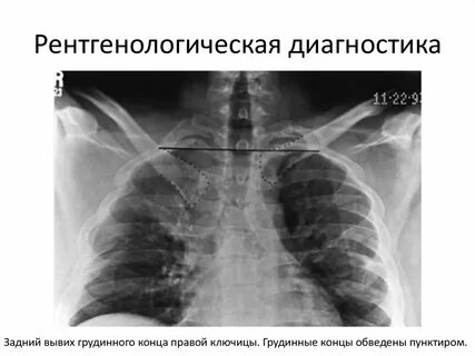 Вывих грудино ключичного