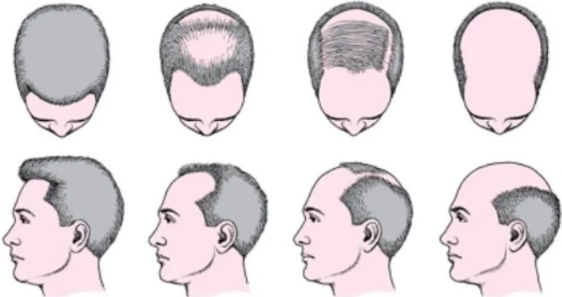 Типы лысин у мужчин. Норвуду-гамильтону. Типы облысения. Виды облысения. Форма роста волос.