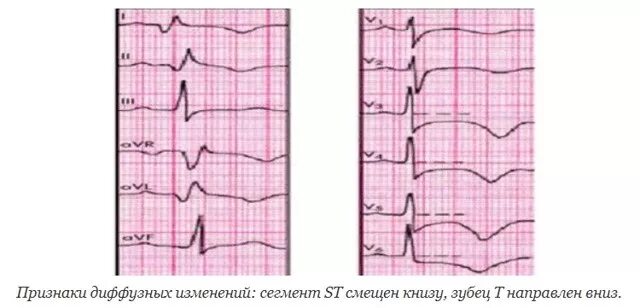 Выраженные диффузные. Диффузные изменения миокарда на экг. экг диффузные неспецифические изменения в миокарде. неспецифические диффузные изменения в миокарде лж экг. кардиограмма неспецифические изменения миокарда.