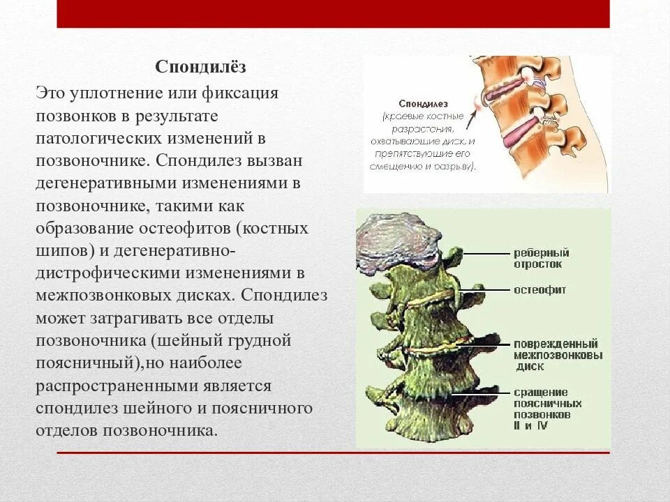 Спондилез l2-l4. Спондилёз пояснично-крестцового отдела l1 l2. Деформирующий спондилез с3-с4. Спондилёз шейного отдела позвоночника что это такое. Начальный спондилез