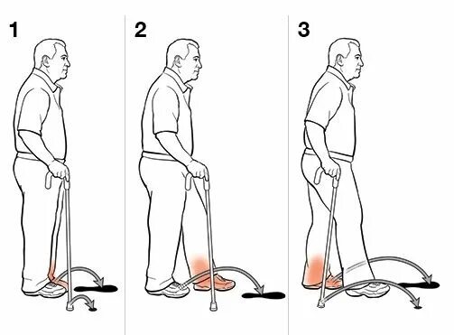 Как подниматься по лестнице после эндопротезирования. Техника хождения с тростью. Правильная ходьба с тростью. Как ходить с тростью. Правильное хождение с тростью.