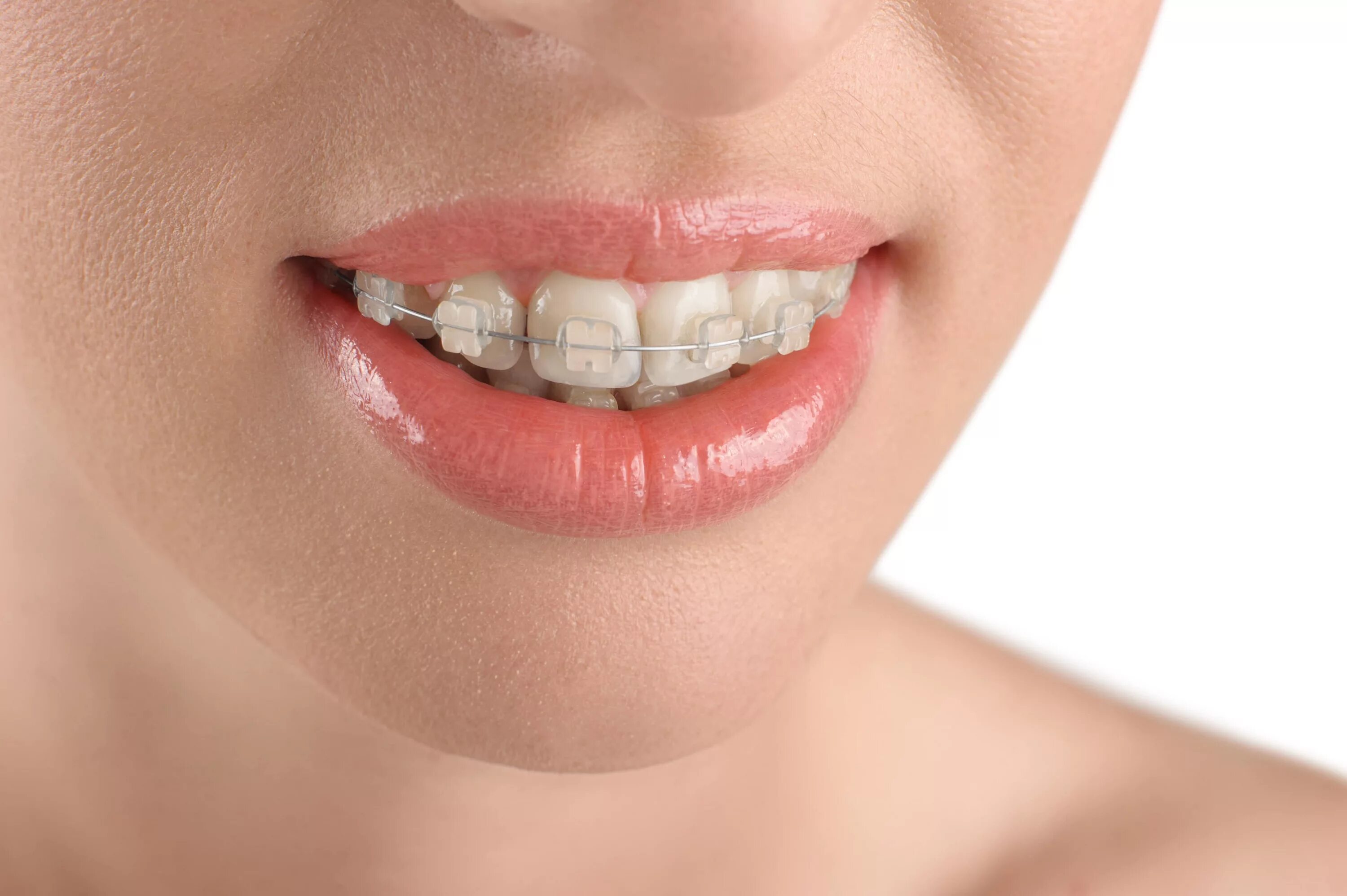 Brackets photo