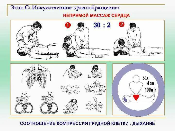 Непрямой массаж сердца и искусственное