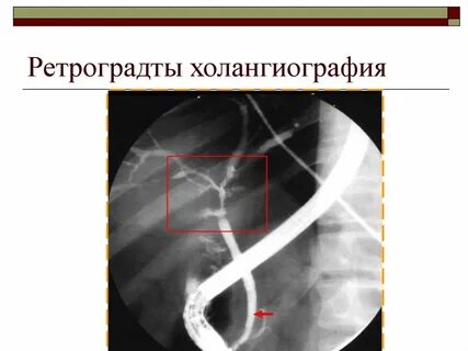 Холангиография
