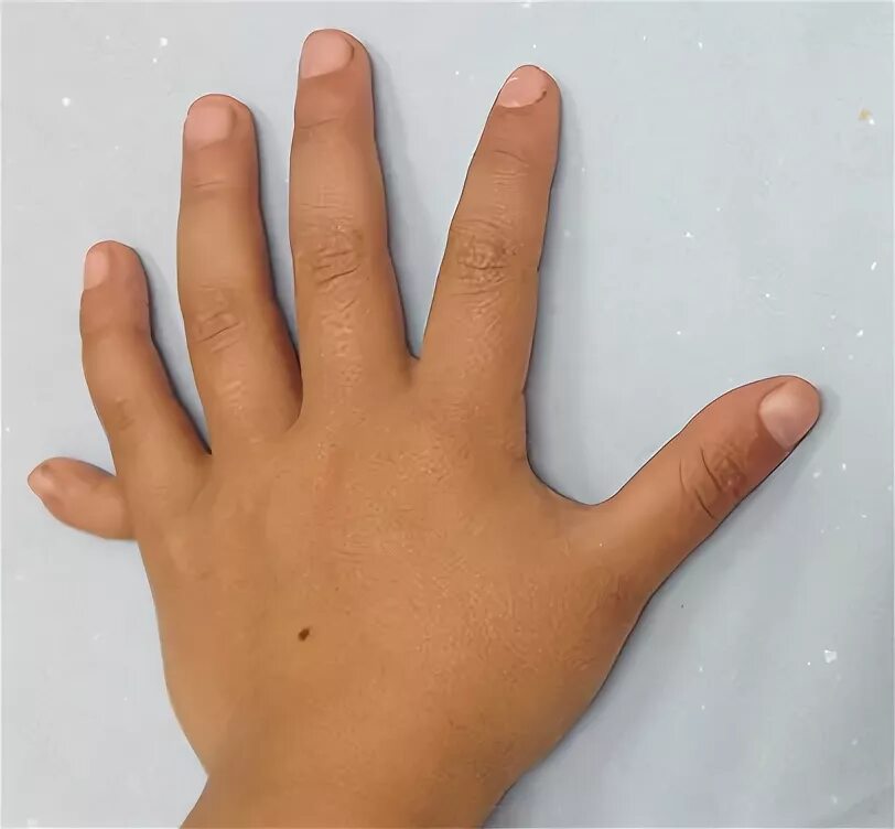 На 1 руке 6 пальцев