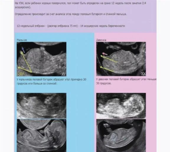 УЗИ пола ребенка. УЗИ определить пол ребенка. УЗИ определение пола. Половой бугорок на УЗИ. На 15 неделе можно узнать пол