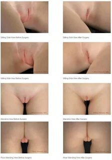 Barbie Pussy Surgery.