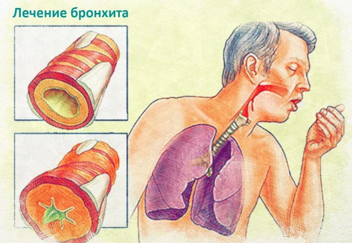 Кашель глубокий грудной с мокротой. Бронхит с обструкцией. Острый бронхит с поражением крупных бронхов. Бр1нхит. Легкие при остром бронхите.