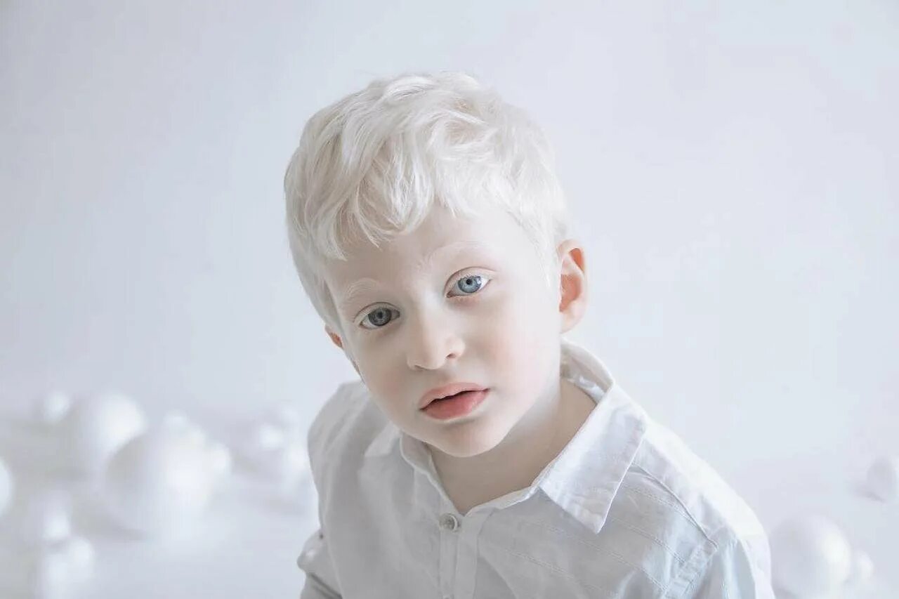 Дэн Баккедаль альбинос. Альбинизм 1в.