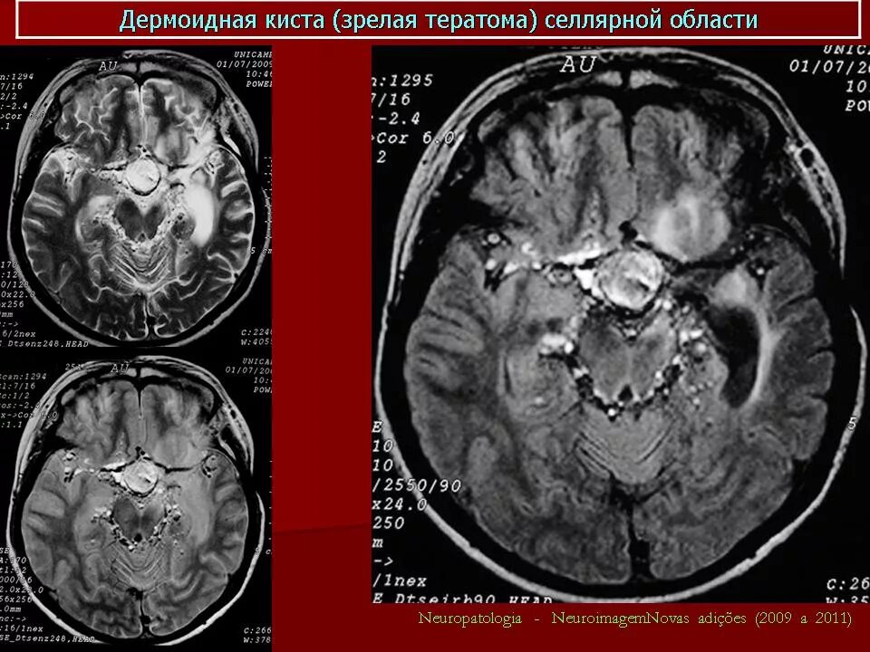 Дермоидная киста головного мозга кт. Дермоидная киста орбиты мрт.