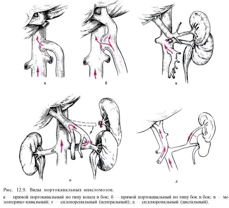 Операция гипертония. Операция Рюотта при портальной гипертензии. Схема лопаточного артериального анастомоза. Операции при портальной гипертензии портокавальные анастомозы. Операции по созданию портокавальных анастомозов.