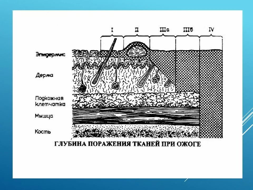 Степень глубины. Классификация ожогов по глубине поражения (по степеням). глубина поражения при ожогах. методы определения глубины термических ожогов. определение глубины ожога.