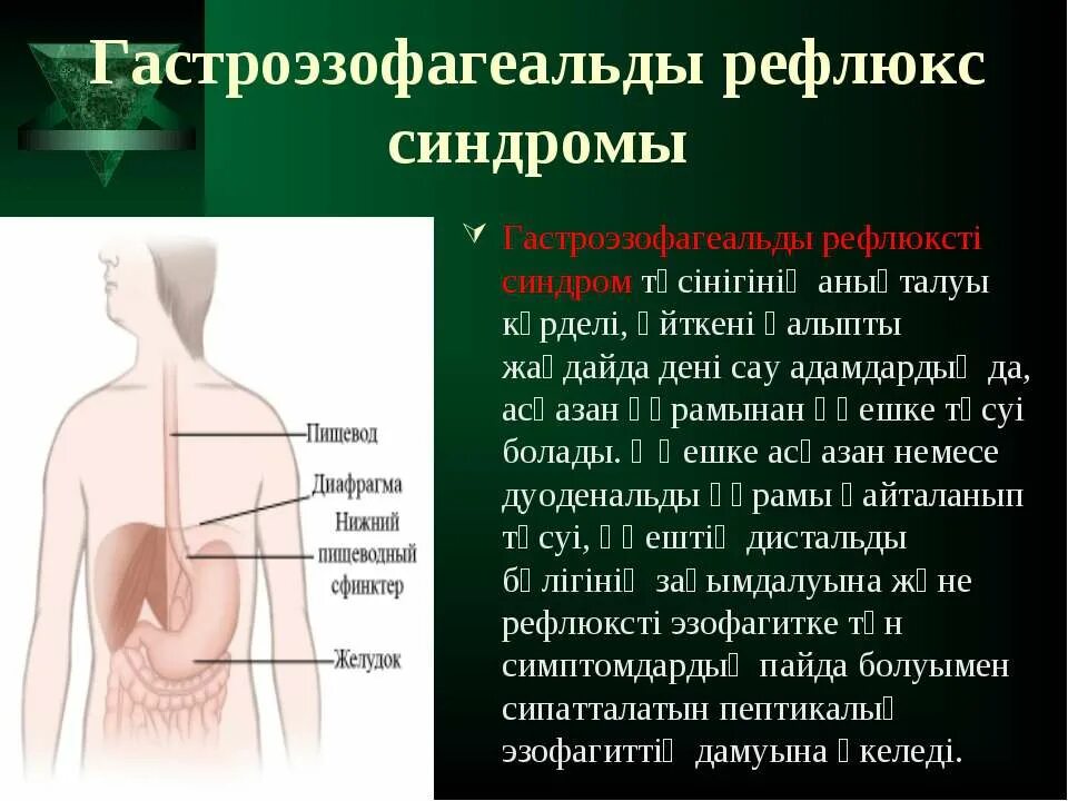 Рефлюкс диафрагмы. Астаны для верхнего рефлюкса.