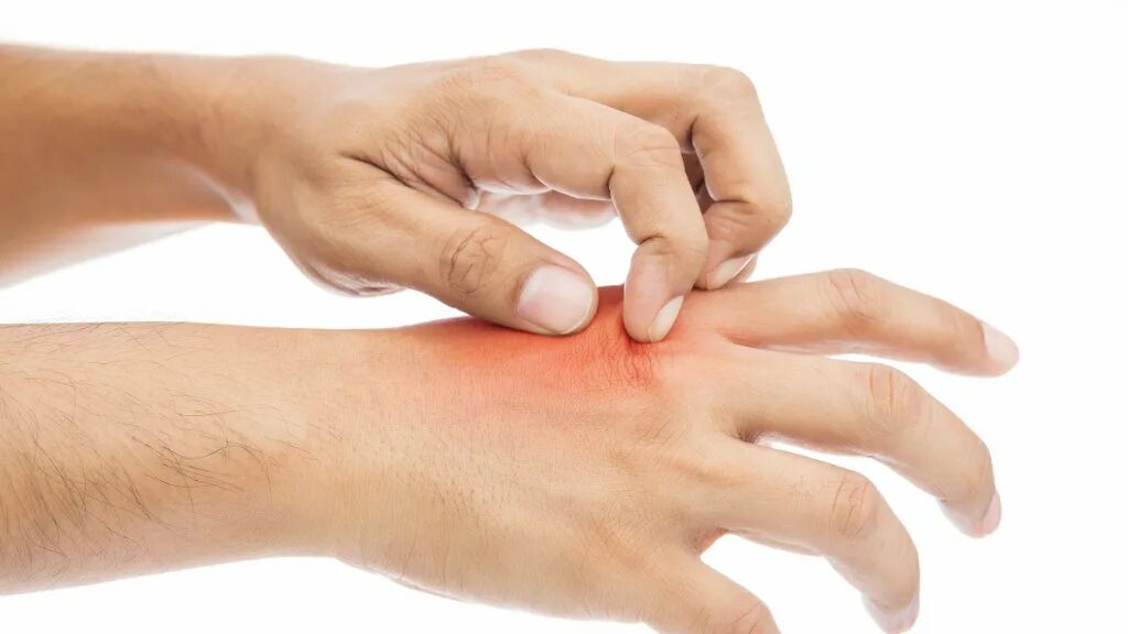 Почему щиплет пальцы. Фотосенсибилизация фотодерматит. Паронихия подногтевая. Отрывание заусенцев на пальцах. Почему щиплет пальцы.