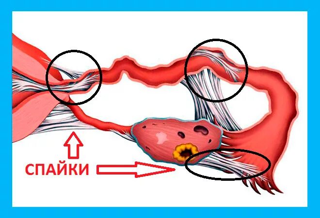 Что такое спайка в маточной трубке. Маточные трубы разрез спайки. Спайка яичника и маточной трубы.