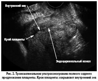 Цервикальный канал 35
