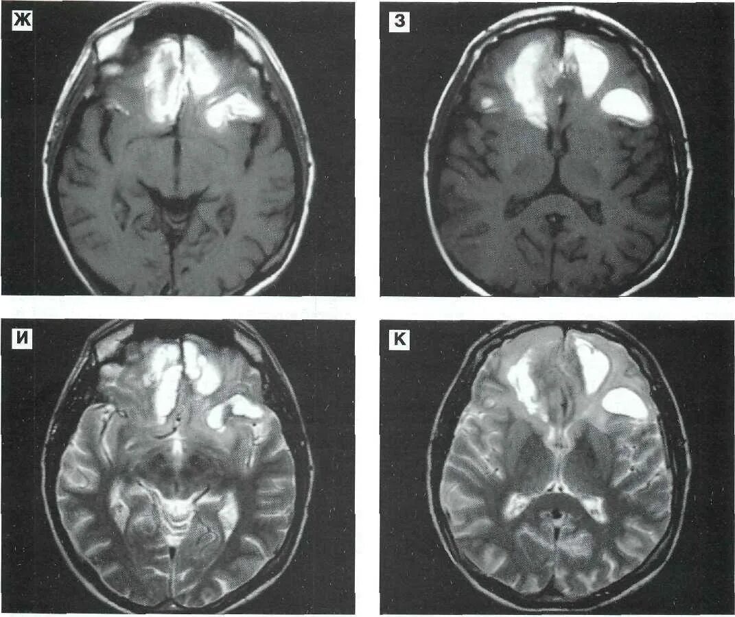 Поражение головного мозга последствия. Синдромы повреждения лобных долей мозга. Опухоль лобной доли синдром. Синдром лобно височной доли. Опухоль головного мозга височной доли снимок кт.