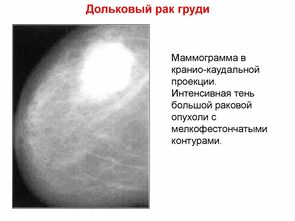 Susp молочной железы что это. Карцинома молочной железы маммография. опухоль молочной железы на рентгене. онкология на маммографии. дольковые опухоли молочной железы.