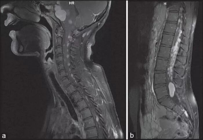 Невринома поясничного отдела позвоночника мрт. Невринома конского хвоста кт. Невринома грудного отдела позвоночника мрт. Невринома Корешков конского хвоста мрт. Опухоль в поясничном отделе