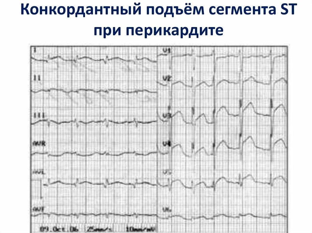 Конкордантный подъем сегмента. Элевация st при перикардите. перикардит на экг. конкордантная элевация сегмента st это. конкордантный подъем сегмента st.