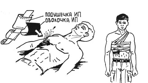 Окклюзионная повязка накладывается при