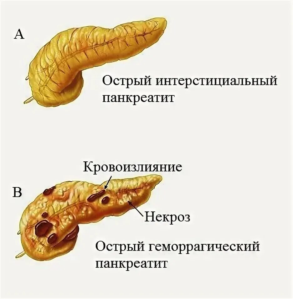 Что такое некроз поджелудочной железы у мужчин. Хронический панкреатит отечная форма. Панкреатит некроз поджелудочной железы. Острый отечный панкреатит. Отечный (интерстициальный) панкреатит.