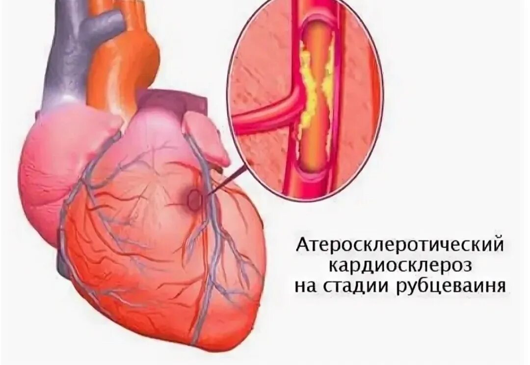 Атеросклеротический кардиосклероз что это простыми. Атеросклеротический кардиосклероз что это простыми