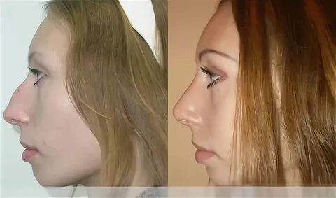 Ринопластика surgery 9mice kai angel текст