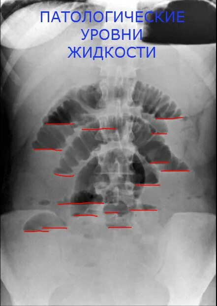 Симптом чаши. Тонкокишечная непроходимость рентген. кишечная непроходимость чаши клойбера. кишечная непроходимость рентген тонкокишечная.