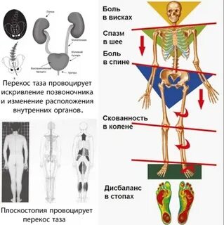 Искривление таза