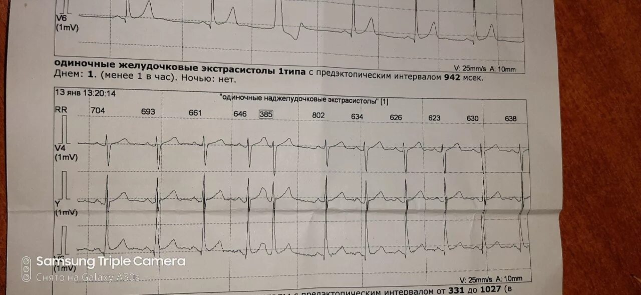 Экстрасистола с блокадой. Атриовентрикулярная блокада 1 степени с экстрасистолами. АВ блокада 1 степени после экстрасистолы. Экстрасистолы на фоне экс. Блокада экстрасистолы