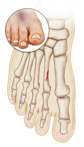 Маршевый перелом плюсневой кости стопы. Маршевый перелом 1 плюсневой кости. Маршевый перелом 3 плюсневой кости. 1 Плюсневая кость стопы перелом. Перелом подошвы