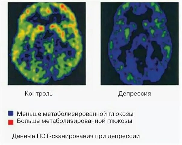 Снимки мозга при депрессии. Активность мозга при депрессии. Изменения в мозге при депрессии. Мозг при депрессии на томографе.