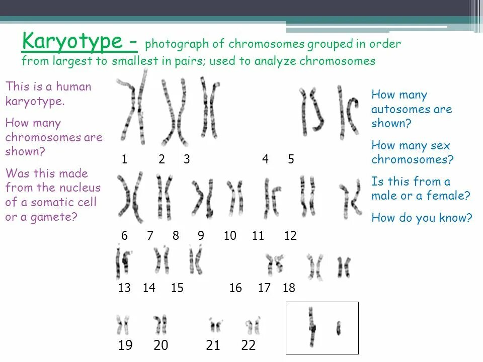 Кариограмма хромосом. Хромосомы кариотип. Синдром де груши кариотип. Хромосомный набор кариотип человека.