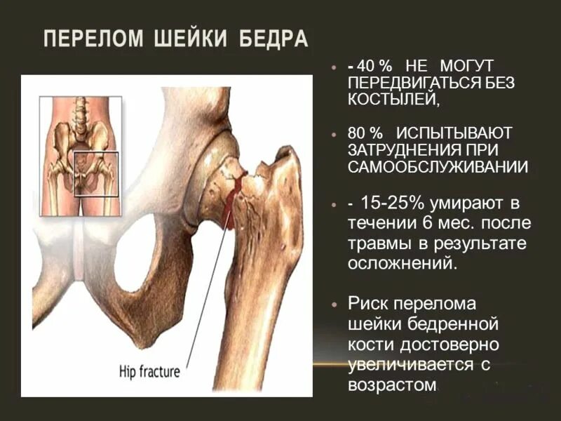Перелом шейки бедра симптомы как определить. Перелом шейки бедренной кости клиника. признаки перелома шейки бедра у пожилых людей 80. характерный симптом при переломе шейки бедра. симптомы, характерные для перелома шейки бедра.