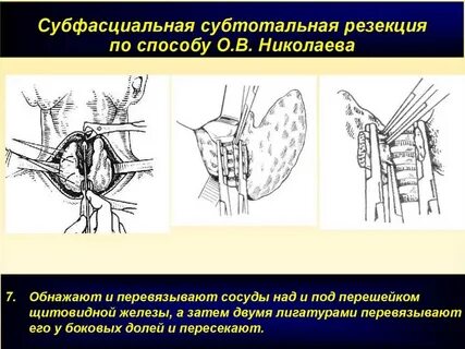 Операция на паращитовидной железе
