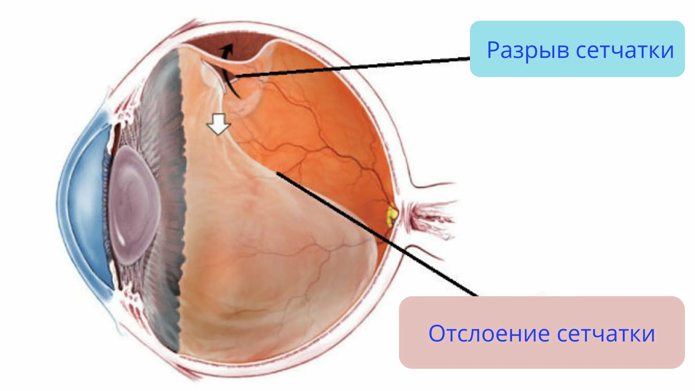 Регматогенная отслойка сетчатки глаза. Субтотальная отслойка сетчатки. Отслоение сетчатки глаза схема. Отслойка сетчатки макулярный разрыв. Повреждение сетчатки